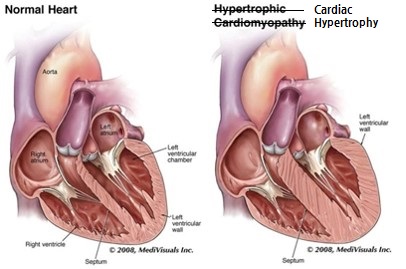 ashdata - [H] Information for you - Hypertrophic Cardiomyopathy라는 질병은? (I)